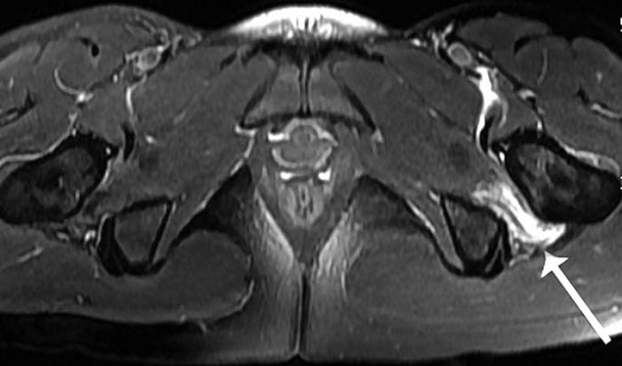 Ischiofemorales Impingement Syndrom Ursache Beratung Übungen und