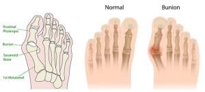 Hallux Valgus - Årsak, råd, tiltak og behandling. Vondt.net