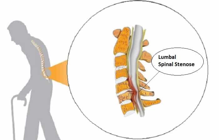 Spinal Stenose I Korsryggen (Lumbal Spinal Stenose) | Symptomer, Råd